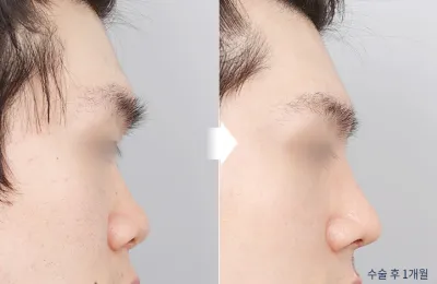 Before & After