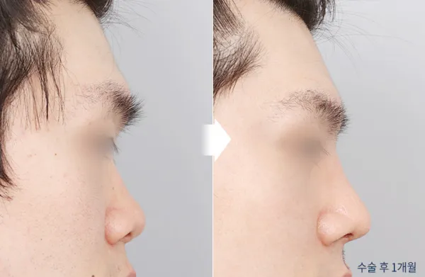 Before/After