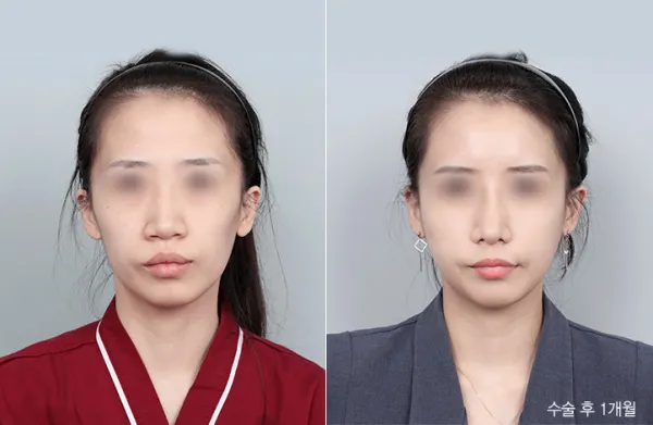 Before/After