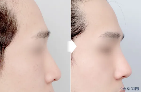 Before/After