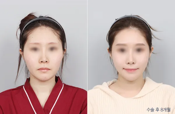 Before/After