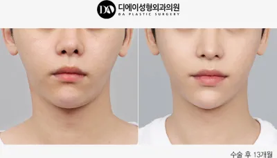 Before & After