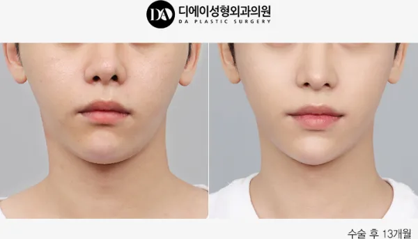 Before/After