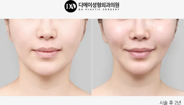 Before/After