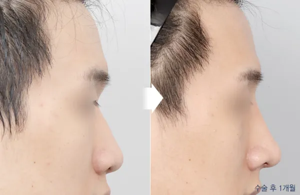 Before/After