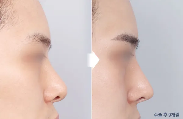 Before/After