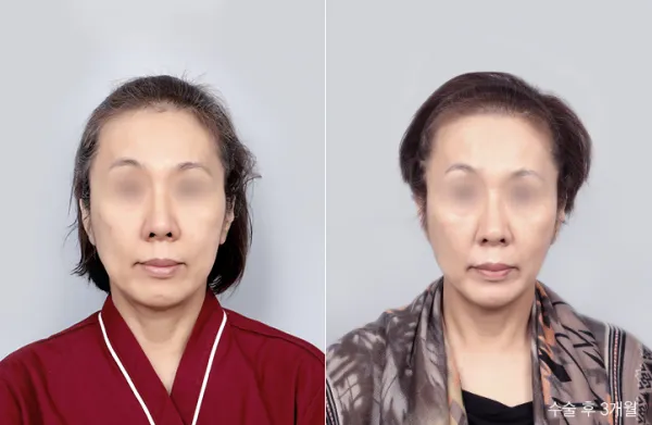 Before/After