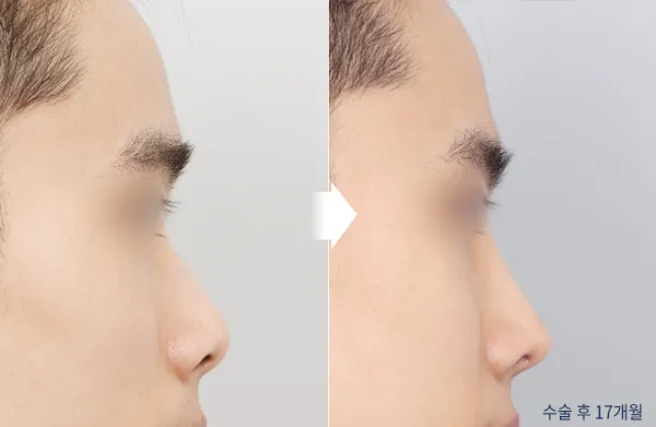 Before/After