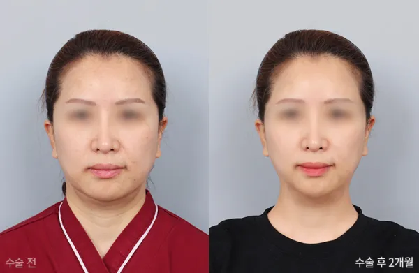 Before/After