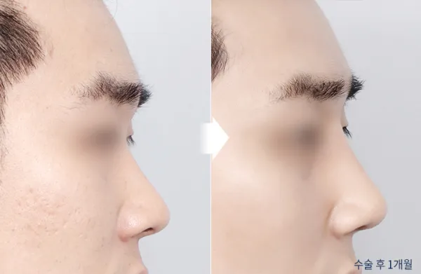Before/After
