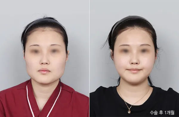 Before/After