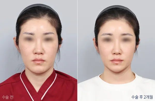 Before/After