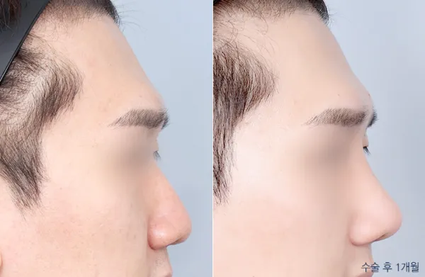 Before/After