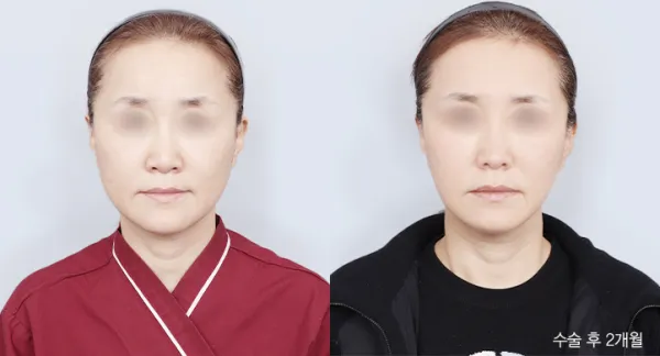 Before/After
