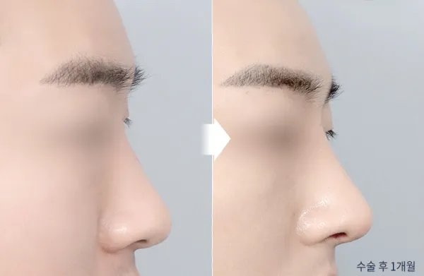 Before/After