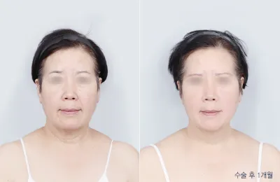 Before & After