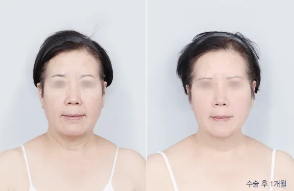 Before/After