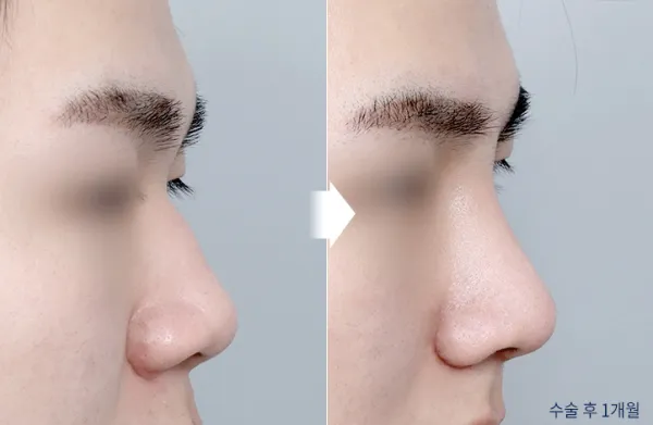 Before/After