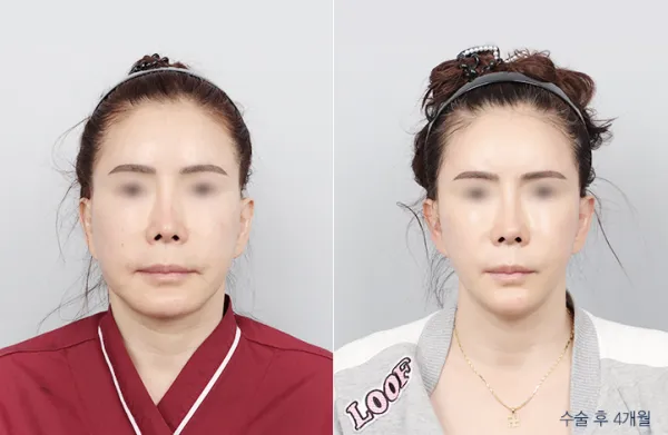 Before/After