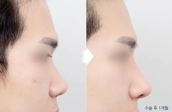 Before/After