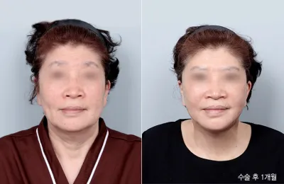 Before & After