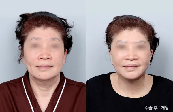 Before/After