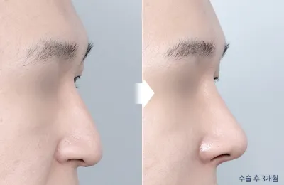 Before & After