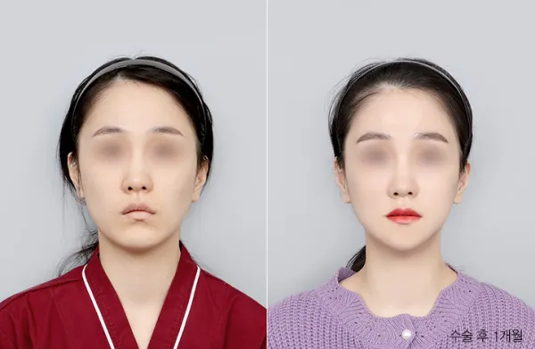 Before/After