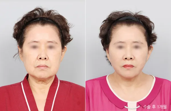 Before/After