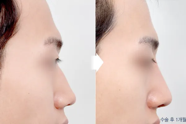 Before/After