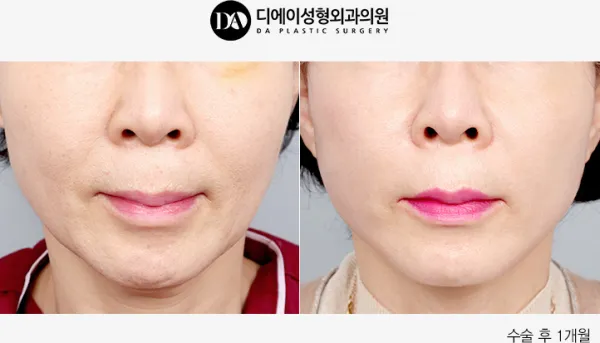 Before/After