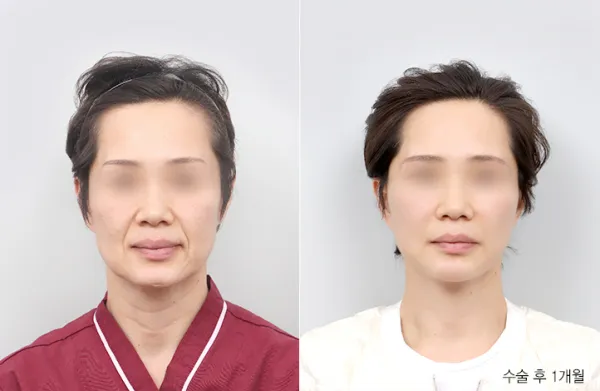 Before/After