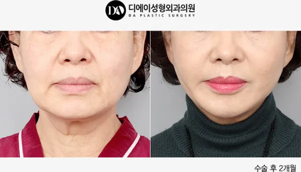 Before/After