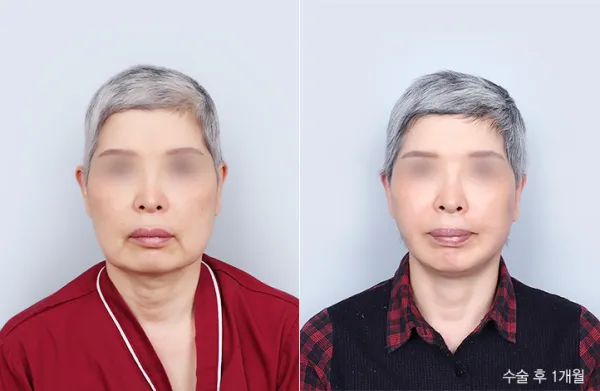 Before/After