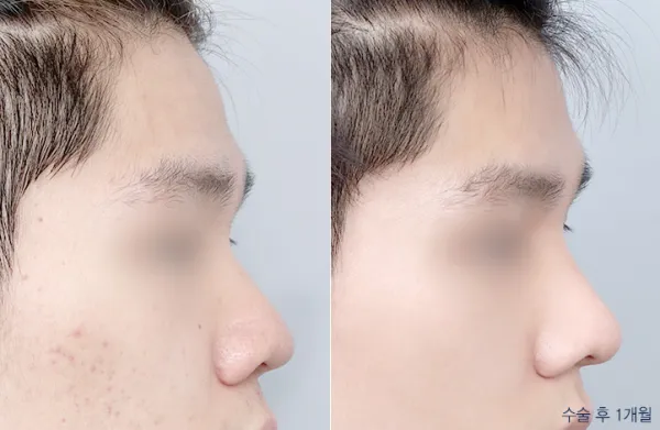 Before/After