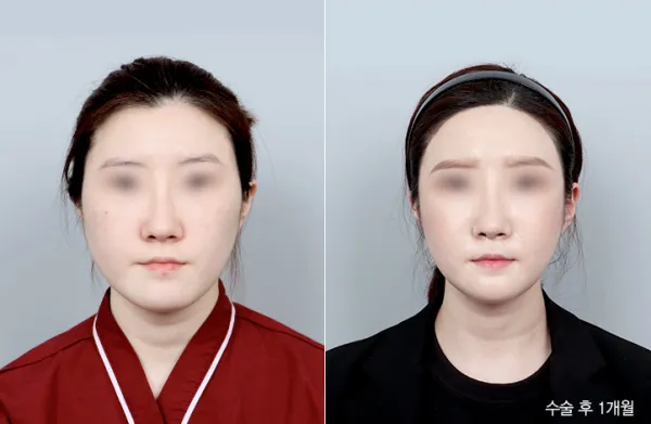 Before/After