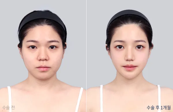 Before/After