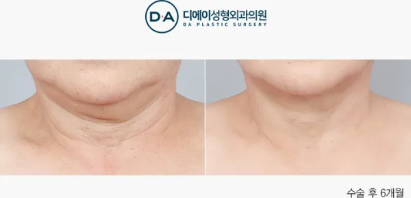 Before/After