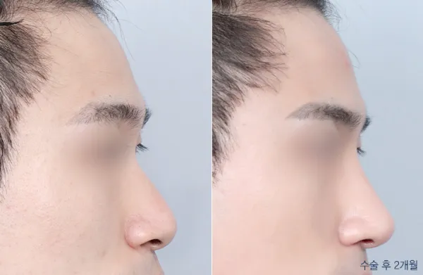 Before/After