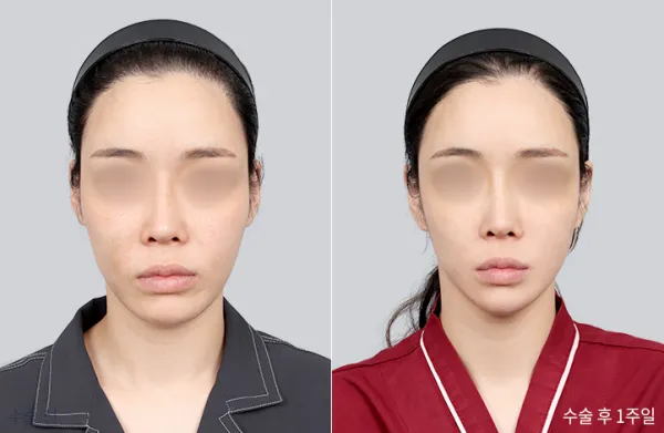 Before/After