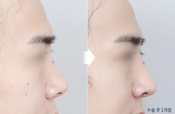 Before/After