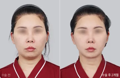 Before & After