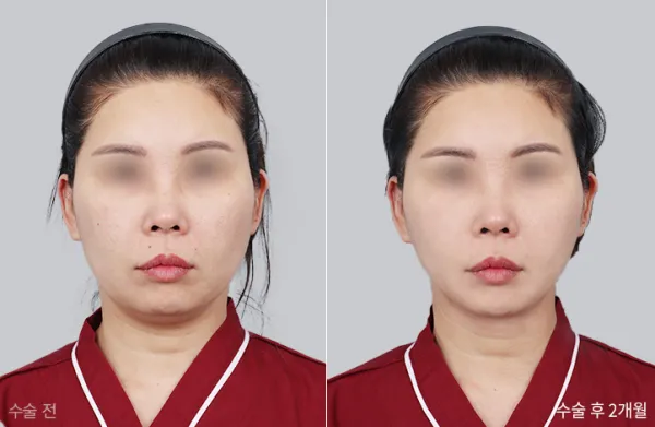 Before/After
