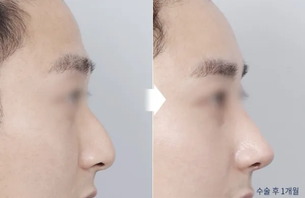 Before/After
