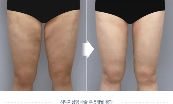 Before/After