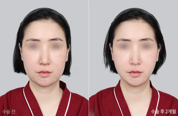 Before/After