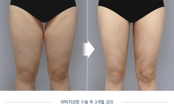 Before/After