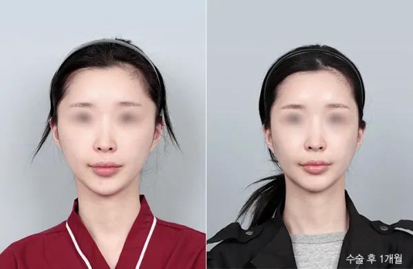 Before/After