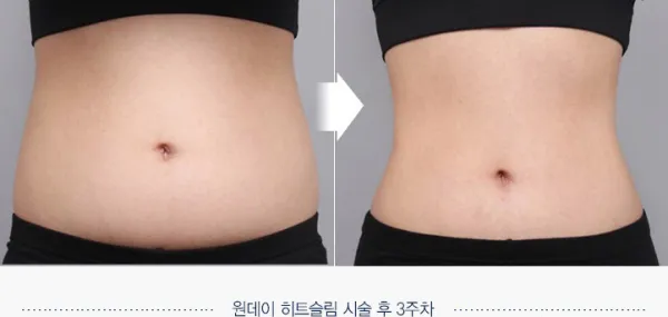 Before/After