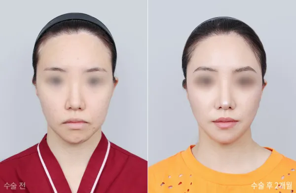 Before/After